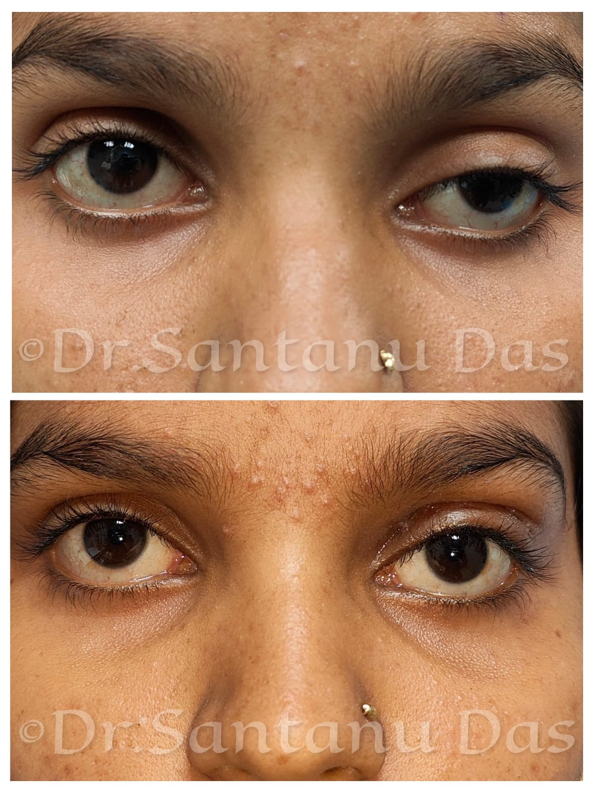 Ptosis Outcome 1
